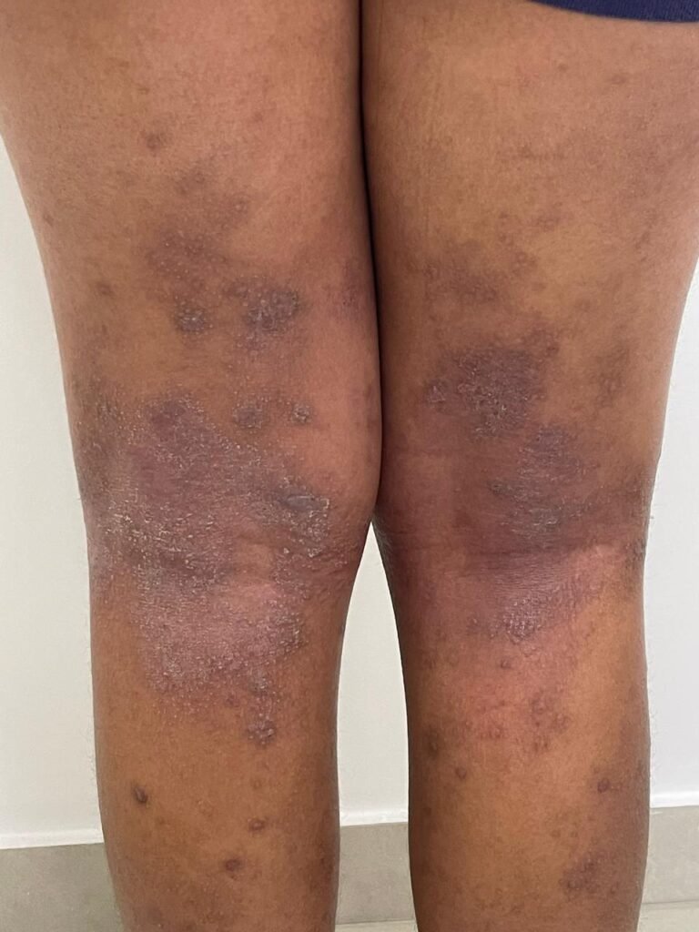 Capa da postagem A dermatite atópica melhora conforme a criança cresce?