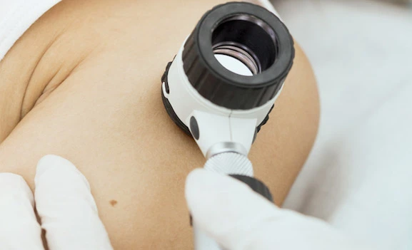 Foto de Melanoma malígno