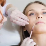 Bioestimuladores de colágeno