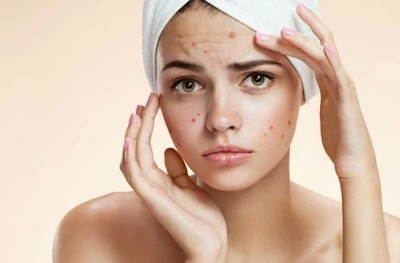 Foto de Acne