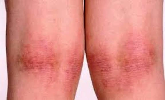 Foto de Dermatite atópica