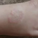 Granuloma anular