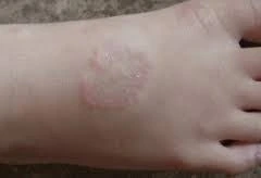 Foto de Granuloma anular