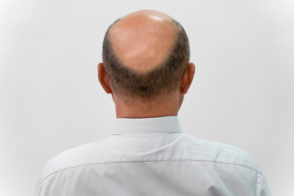 Foto de Alopecia Androgenética (Calvície)