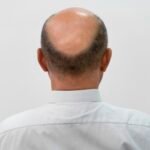Alopecia Androgenética (Calvície)
