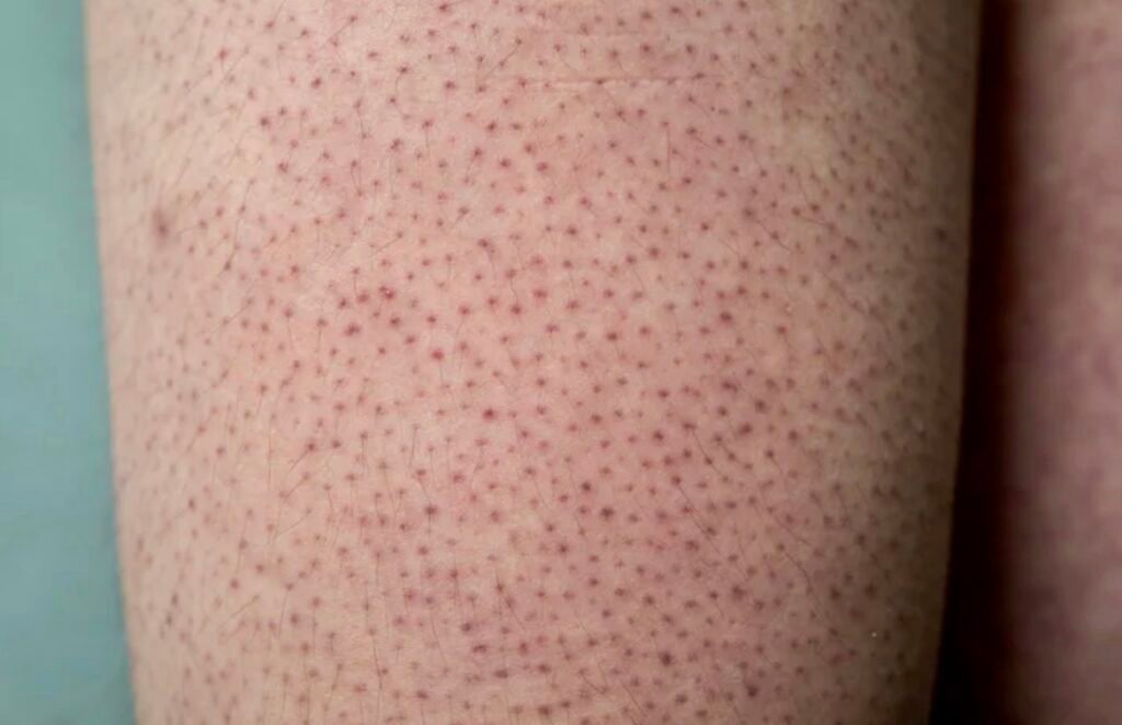 Foto de Queratose pilar