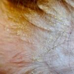 Dermatite seborréica do lactente (crosta láctea)