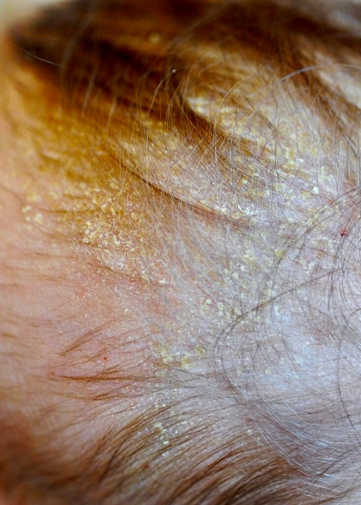 Foto de Dermatite seborréica do lactente (crosta láctea)