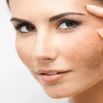 Melasma