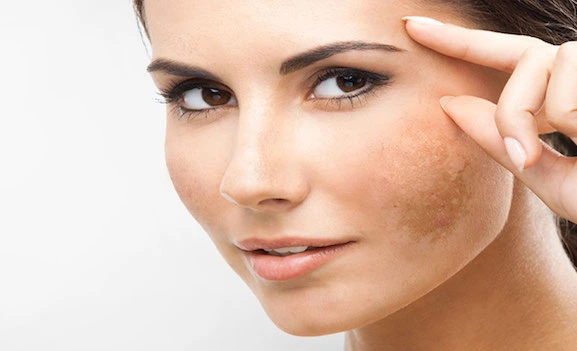 Foto de Melasma