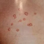 Molusco contagioso