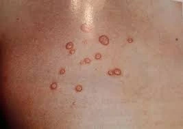 Foto de Molusco contagioso