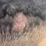 Tinea capitis