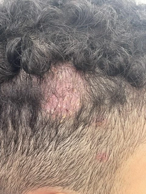 Foto de Tinea capitis