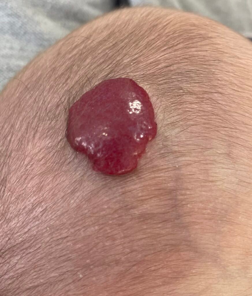 Foto de Hemangioma infantil